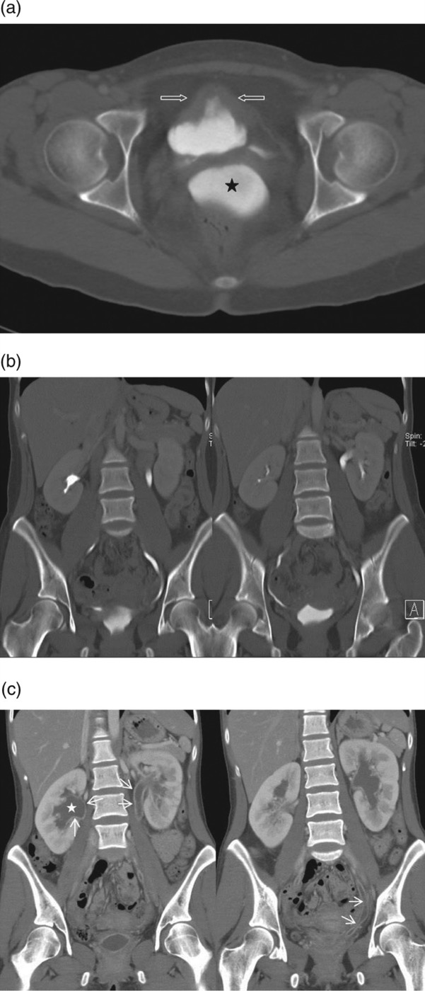 CT urography in ketamine uropathy: axial image of a thick-walled small bladder with a vesicovaginal fistula, a coronal image without hydronephrosis, and coronal images six months later with bilateral hydroureteronephrosis