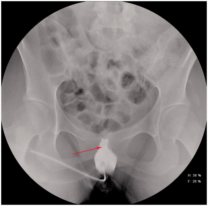 Cystogram showing a small, contracted, tower-shaped bladder