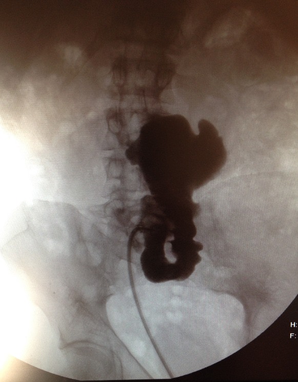 Pouchogram of a contrast-filled colonic reservoir drained by a catheter