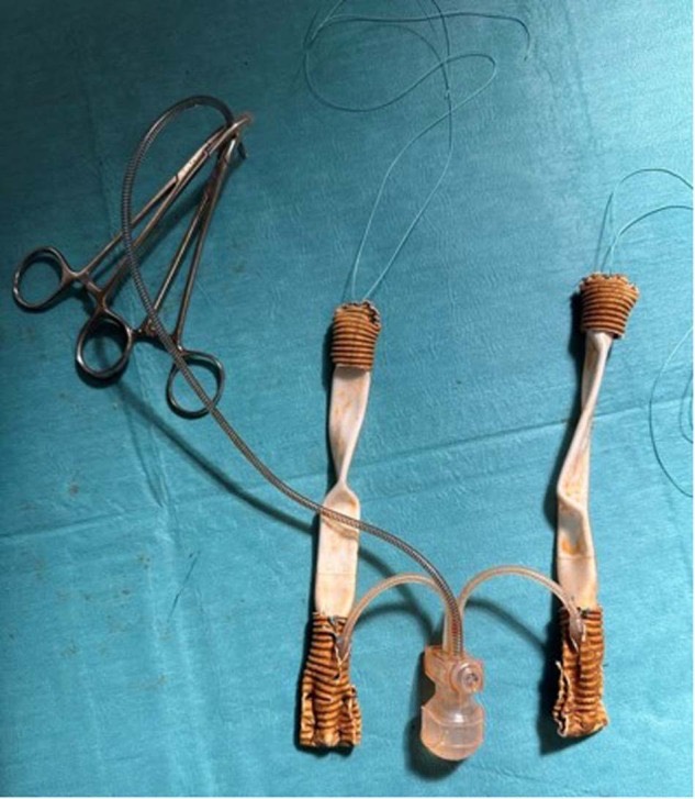 Three-piece inflatable penile prosthesis on the back table, with a woven vascular-graft sock over the proximal end of each cylinder for pubic anchoring and a graft cap over each distal tip