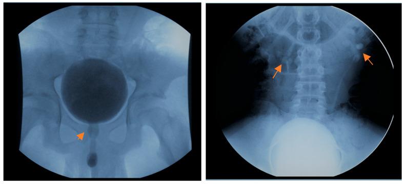 Voiding cystourethrogram showing a dilated posterior urethra and bilateral vesicoureteral reflux in an adolescent with posterior urethral valves