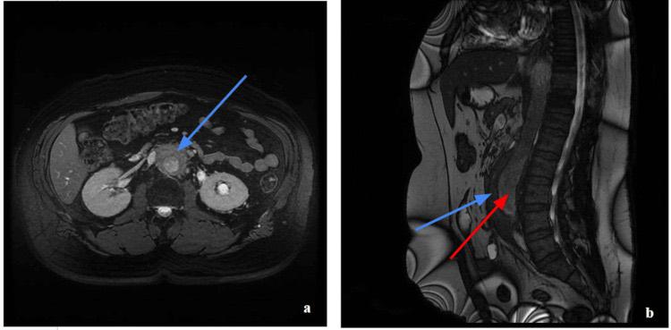 Axial and sagittal abdominal MRI showing periaortic soft-tissue thickening of retroperitoneal fibrosis and a distal aortic aneurysm