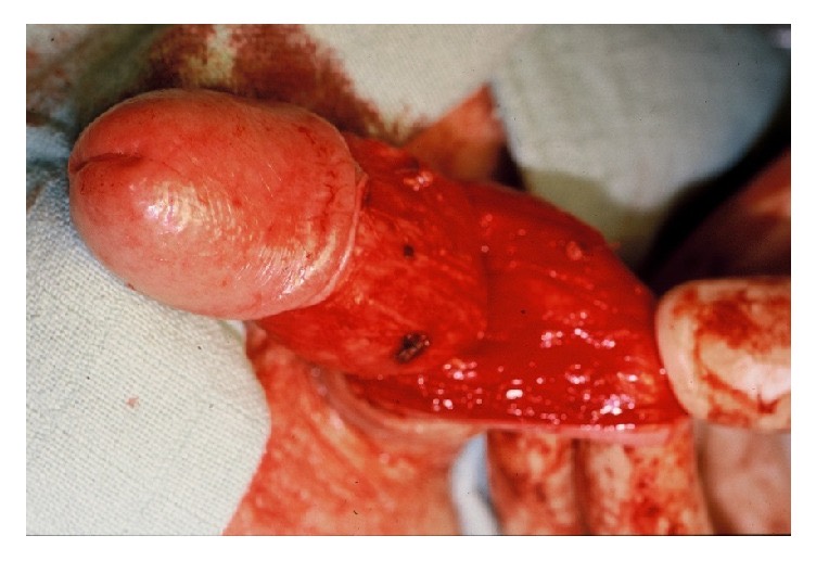 Penis degloved along Buck's fascia after a circumferential subcoronal incision, exposing the penile urethra