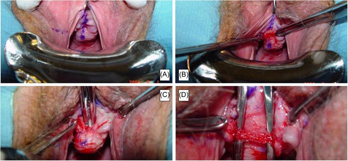 Transvaginal sling incision: anterior vaginal wall marking, incision exposing the mesh edge, right-angle clamp behind the mesh and fully exposed sling