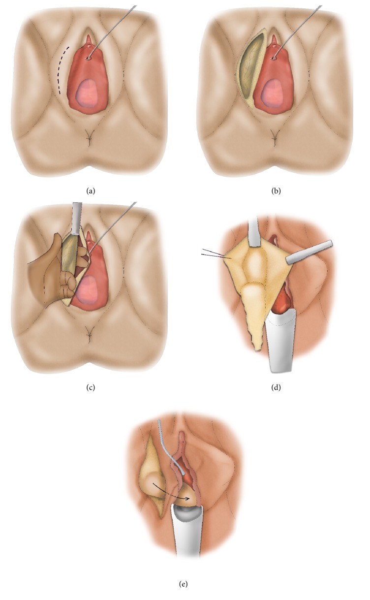 Five-panel drawing of Martius flap harvest: labial incision, exposure and finger mobilization of the labial fat pad, and transfer of the pedicled pad through a subcutaneous tunnel to the urethra