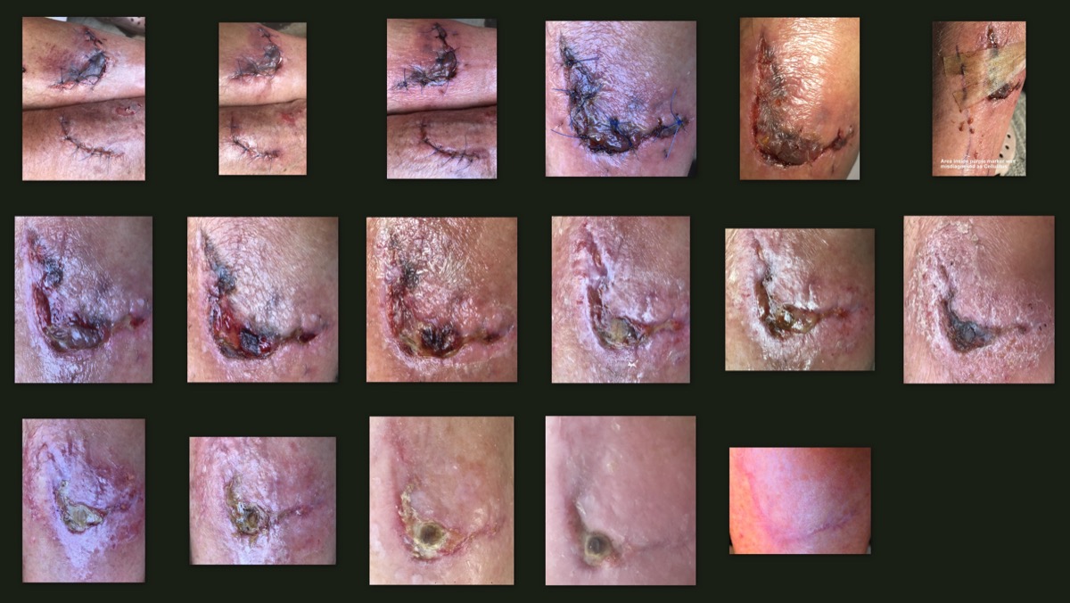 Serial photographs of a healing skin abrasion over 30 days showing progression from acute injury through remodeling